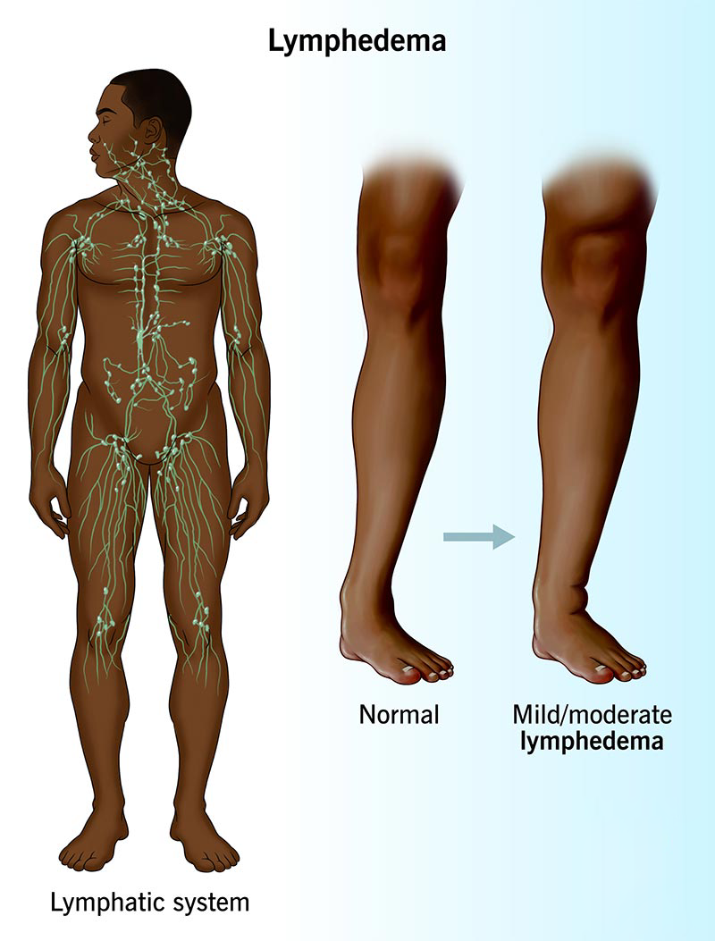 Lymphedema Therapy at Home